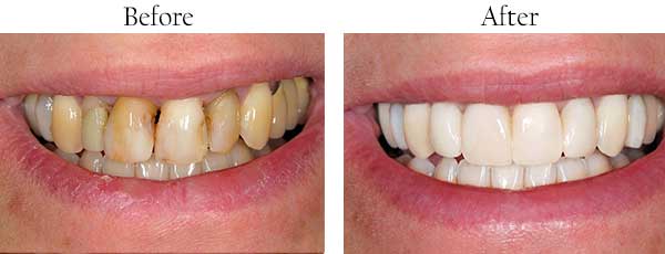 Smile Gallery - Pasadena Dentist Cosmetic and Family Dentistry
