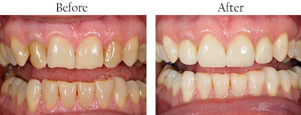 Smile Gallery - Pasadena Dentist Cosmetic and Family Dentistry