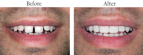 Smile Gallery - Pasadena Dentist Cosmetic and Family Dentistry