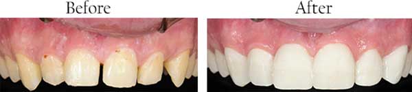 Smile Gallery - Pasadena Dentist Cosmetic and Family Dentistry