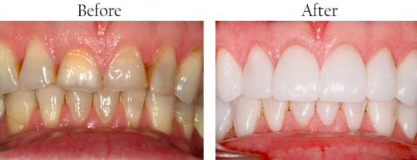 Smile Gallery - Pasadena Dentist Cosmetic and Family Dentistry