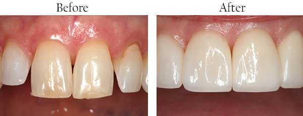 Smile Gallery - Pasadena Dentist Cosmetic and Family Dentistry