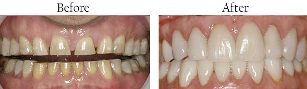 Smile Gallery - Pasadena Dentist Cosmetic and Family Dentistry