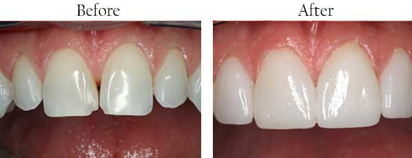 Smile Gallery - Pasadena Dentist Cosmetic and Family Dentistry